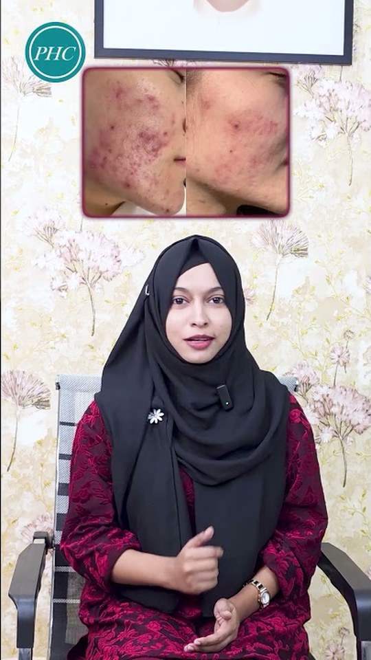 Before-and-after close-up of a patient's cheek showing acne scarring improvement, with the patient in a hijab speaking directly to camera.